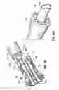 Fig. 24 - End-to-end anastomosis instrument and method for performing same