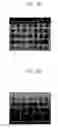 Fig. 05 - Recessed gate structures including blocking members, methods of forming the same, semiconductor devices having the recessed gate structures and methods of forming the semiconductor devices