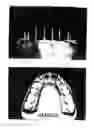 Fig. 04 - Dental crowns