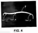 Fig. 05 - Ergonomic apparatus for keyboard