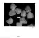 Fig. 02 - PMMA bone cement containing antibiotic/antibiotics