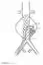 Fig. 07 - Devices and methods for treatment of vascular aneurysms