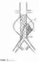 Fig. 08 - Devices and methods for treatment of vascular aneurysms