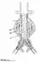 Fig. 16 - Devices and methods for treatment of vascular aneurysms