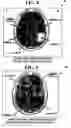 Fig. 08 - Method and system for diagnosis of neuropsychiatric disorders including chronic alcoholism