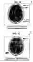 Fig. 10 - Method and system for diagnosis of neuropsychiatric disorders including chronic alcoholism