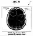 Fig. 11 - Method and system for diagnosis of neuropsychiatric disorders including chronic alcoholism