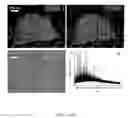 Fig. 02 - ANALYSIS OF TISSUE SAMPLES SURROUNDING MALIGNANCIES
