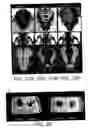 Fig. 55 - Nell peptide expression systems and bone formation activity of nell peptide