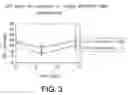 Fig. 03 - Method of lowering intraocular pressure
