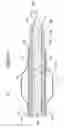 Fig. 06 - Apparatus and method for treating occluded vasculature