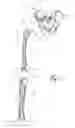 Fig. 02 - Leg alignment for surgical parameter measurement in hip replacement surgery