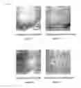 Fig. 10 - Disc herniation treating method and apparatus