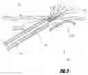 Fig. 04 - Methods and apparatus for introducing tumescent fluid to body tissue