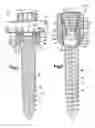 Fig. 03 - Apparatus for connecting a longitudinal member to a bone portion