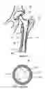 Fig. 05 - Bone implant device and methods of using same