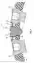 Fig. 04 - Bone screw locking mechanism and method of use