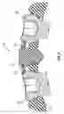 Fig. 06 - Bone screw locking mechanism and method of use