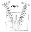 Fig. 09 - Orthopedic implant rod reduction tool set and method