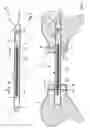 Fig. 05 - Device for lengthening bones or bone parts