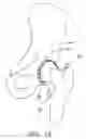 Fig. 05 - Segmented joint distractor