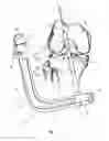 Fig. 04 - Graft fixation device and method