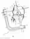 Fig. 07 - Graft fixation device and method
