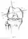 Fig. 10 - Graft fixation device and method