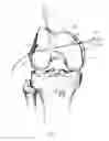 Fig. 12 - Graft fixation device and method