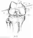 Fig. 18 - Graft fixation device and method