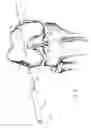 Fig. 19 - Graft fixation device and method