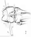 Fig. 22 - Graft fixation device and method