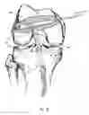 Fig. 24 - Graft fixation device and method