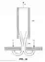 Fig. 11 - Self-closing surgical clip for tissue