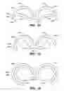 Fig. 14 - Self-closing surgical clip for tissue