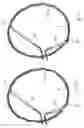 Fig. 15 - Embolic protection device