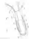 Fig. 22 - Embolic protection device