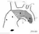 Fig. 05 - Endovascular device for entrapment of participate matter and method for use