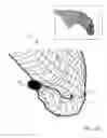 Fig. 06 - Endovascular device for entrapment of participate matter and method for use
