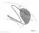 Fig. 07 - Endovascular device for entrapment of participate matter and method for use
