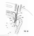 Fig. 09 - Knotless suture lock and bone anchor implant method