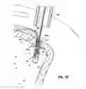 Fig. 10 - Knotless suture lock and bone anchor implant method