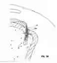 Fig. 12 - Knotless suture lock and bone anchor implant method