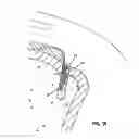Fig. 13 - Knotless suture lock and bone anchor implant method