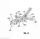 Fig. 19 - Knotless suture lock and bone anchor implant method