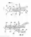 Fig. 20 - Knotless suture lock and bone anchor implant method
