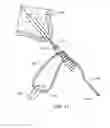 Fig. 23 - Knotless suture lock and bone anchor implant method
