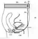Fig. 01 - Non-invasive modulation of the autonomic nervous system