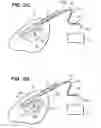 Fig. 05 - Systems and methods for creating a lesion using transjugular approach