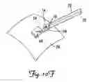Fig. 09 - Epicardial lead fixation system